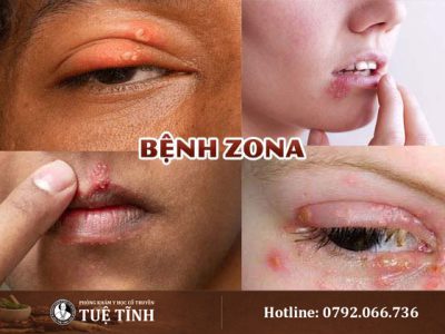 benh-zona-0
