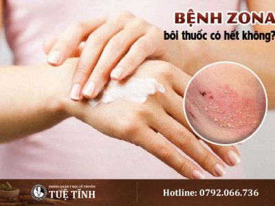 benh-zona-thuoc