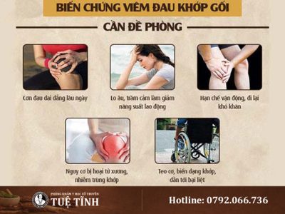 bien-chung-dau-khop-goi