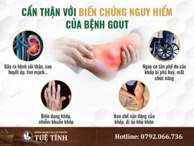 bien-chung-gout
