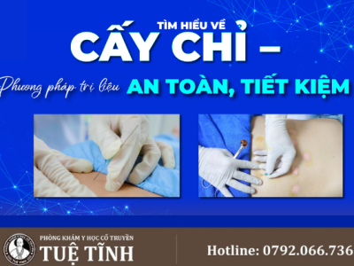 cấy chỉ (3)