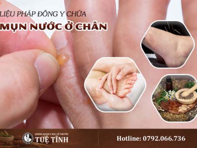 mun-nuoc-o-chan-dieu-tri