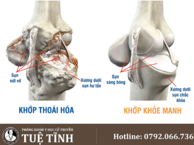thoái hóa khớp